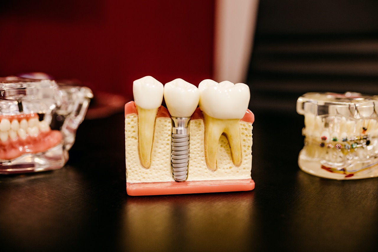 Implanty zębów – co warto o nich wiedzieć?